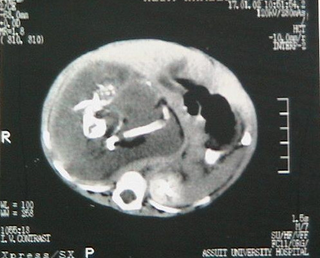 Illustration for article titled Acude a urgencias por un fuerte dolor de estómago y le encuentran los restos de su gemelo parcialmente formado